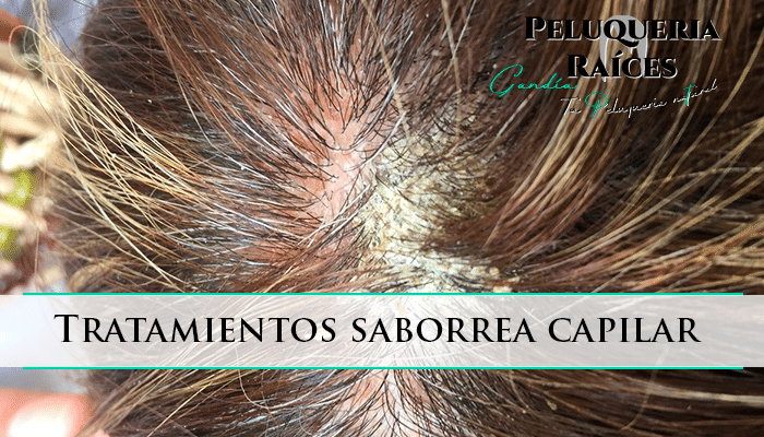 tratamientos-saborrea-capilar